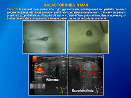 Image result for Galactorrhea
