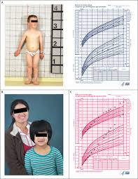 Gigantism, condition in which an animal or plant is far greater than normal in size. Gigantism And Acromegaly Due To Xq26 Microduplications And Gpr101 Mutation Nejm