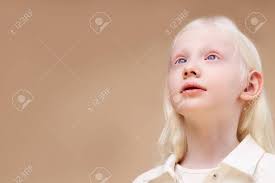 アルビノ。白皮症症候群のかわいい白人の少女、彼女は見上げる。自然の美しさと人々の多様性の概念の写真素材・画像素材 Image 148076149