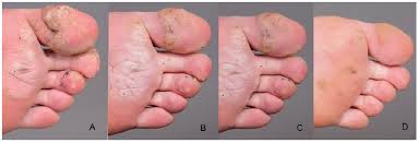 1st line therapies include cryotherapy and topical salicylic acid. Nonavalent Human Papillomavirus Vaccination As A Treatment For Skin Warts In Immunosuppressed Adults A Case Series Html Acta Dermato Venereologica