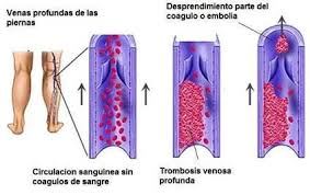 La mayoría de los casos se da en venas superficiales o profundas de las los trombos superficiales se producen frecuentemente en las venas safenas varicosas causando. Trombosis Venosa Profunda Trombosis Venosa Profunda Trombosis Venosa Trombosis