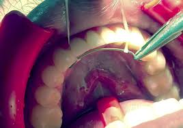 We did not find results for: How Are Braces Removed Premier Orthodontics