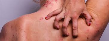 Image result for Atopic eczema atopic dermatitis