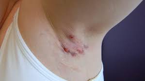 Schweissdrusenentzundung Acne Inversa Deximed