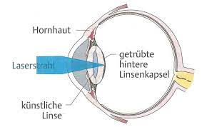 Doz Dr Richard Maier Facharzt Fur Augenheilkunde Und Optometrie In Graz Nachstar Laser