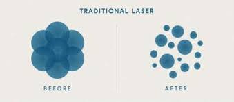 There are a number of people in columbus, ohio turning to our tattoo removal services for various reasons. Tattoo Removal Columbus Ohio Laser Tattoo Removal Dayton Ohio