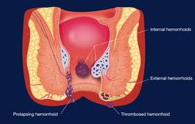 Image result for Hemorrhoid