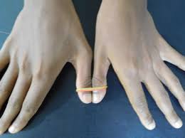 The ulnar collateral ligament of the thumb (first metacarpophalangeal joint) is frequently injured in sporting pursuits, leading to pain and instability in the thumb. Simultaneous Combined Complete Tear Of Radial And Ulnar Collateral Ligaments Of Thumb In An Adolescent Bmj Case Reports