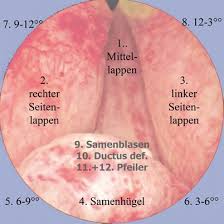 Die Radikale Transurethrale Resektion Der Prostata Springerlink