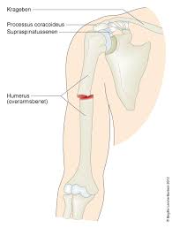I tillegg finnes kombinasjonsskader der en knokkel har brudd og den andre knokkelen har gått ut av ledd, enten ved. Overarmsbrudd I Skaftet Pa Beinet Nhi No