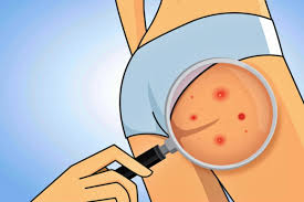 A couple of various circumstances happen to make the buttocks a typical spot for boils to develop. Boil On The Buttocks With Natural Remedies Skin Care Top News