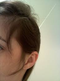Working with charities and experts for the benefits of patients. Bicalutamide Casodex My Experience Heralopecia Forums