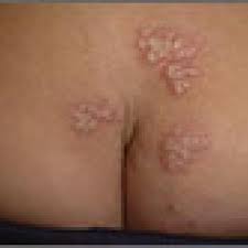 Itching or burning is followed an hour or two later by an irregular cluster of small, closely grouped, often umbilicated vesicles on a red base. Recurrent Vesicular Rash Over The Sacrum Mdedge Family Medicine