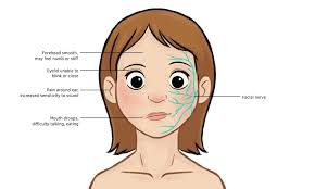 Bell S Palsy Health