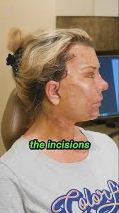 Neck Lift Recovery Day By Day — Vado Plastic Surgery