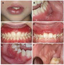 Orofacial Granulomatosis And Oral Crohn Disease Institutt For Oral Biologi