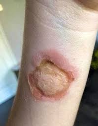 Image result for spinne biss haut reaktion