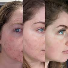 Halvvägs (4 månader) och äntligen lever jag ett liv med självförtroende  utan smink och blir av med envis melasma efter graviditeten! : r/Accutane