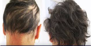 However, hair loss is a common side effect of immunosuppressant drugs,* which are sometimes used to treat multiple sclerosis (ms). Alopecia Areata Testimonials Coimbra Protocol This Is Ms Multiple Sclerosis Knowledge Support Community