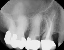 No se cepille esta noche. Root Canal Treatment Of Maxillary Premolars With Three Roots