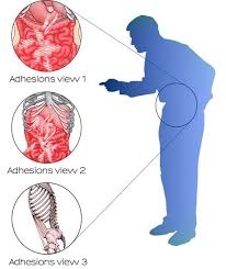 Pin On Adhesions