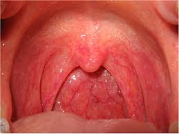 The infection may also affect other. Pharyngitis Wikipedia