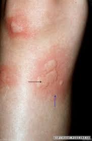 Chronic Spontaneous Urticaria Is A Severe Skin Condition One Of The Symptoms That People With Csu Chronic Spontaneous Urticaria Urticaria Idiopathic Urticaria