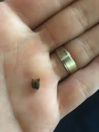 Ouch 6 5 Mm 3 Months To Pass Kidneystones