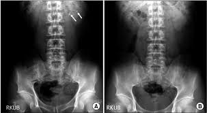 A Preoperative Kidney Ureter Bladder Kub Abdominal Radiograph Of A Download Scientific Diagram