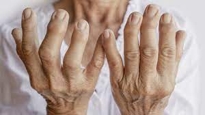 Maybe you would like to learn more about one of these? Artritis Que Es Sintomas Tratamiento Y Diagnostico
