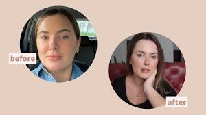 MY EYELID SURGERY AND BROW LIFT - RECOVERY & RESULTS