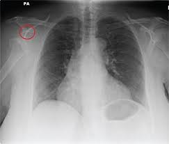 Image result for Incidental Imaging Finding