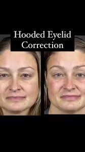 We are in love with this subtle brow lift and hooded eyelid correction  using PDO lifting threads ♥️ , #hoodedeyes #browlift #nonsurgicalfacelift  #vsoftliftusa #pdothreads #brighten #medspa #saladotx ...