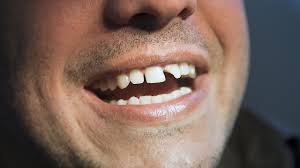 Free shipping & returns at fossil.com. How To Deal With Broken Teeth Tooth Care Youtube