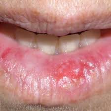 Image result for Lip Cancer