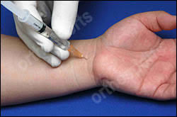 Image result for TFCC Steroid Injection