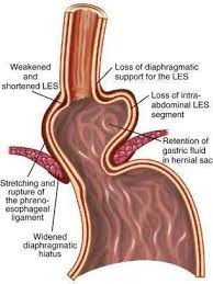 What Is A Hiatal Hernia Health Life Media