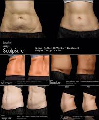 Body Sculpting Anushka Spa Salon West Palm Beach Fl Body Sculpting Body Contouring Surgery Cool Sculpting