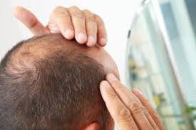 With proper massage, you allow for adequate circulation of blood. Hair Loss Treatment For Men Richmond Bodyvie