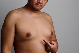 Image result for Gynecomastia