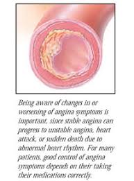 Image result for Angina Pectoris