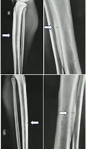Image result for Tibia Stress Fracture