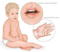 What is hand, foot, and mouth (hfmd) disease? Kementerian Kesihatan Malaysia What Is Hand Foot And Mouth Disease Hand Foot And Mouth Disease Is An Illness That Causes Sores In Or On The Mouth And On The Hands Feet And Sometimes The Buttocks And Legs