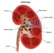 Kidney Stones Northwestern Medicine