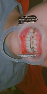 Mempunyai warna keramik mungkin adalah salah satu. Nisa Behel Kasemen Posts Facebook