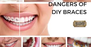 Shoup radio to never miss another show. The Untold Dangers Of Do It Yourself Orthodontics Diy Teeth Straightening Orthodontics Orthodontics Smile