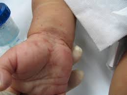 Image result for human scabies