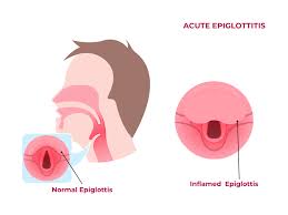 Image result for Epiglottitis