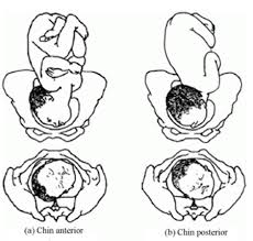 Image result for Brow Presentation