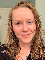 Acne treatment success story after 1.5 years